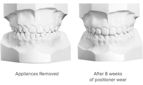products-tooth-positioner-results